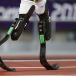prosthesis-8e06848e7b26622a27193f099ff306b8