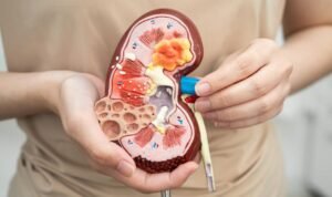 Gejala Kanker Ginjal yang Sering Terlewat dan Perlu Diwaspadai