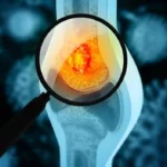 Gejala Kanker Tulang yang Sering Diabaikan, Nyeri Tidak Boleh Disepelekan