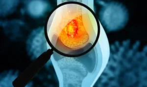 Gejala Kanker Tulang yang Sering Diabaikan, Nyeri Tidak Boleh Disepelekan