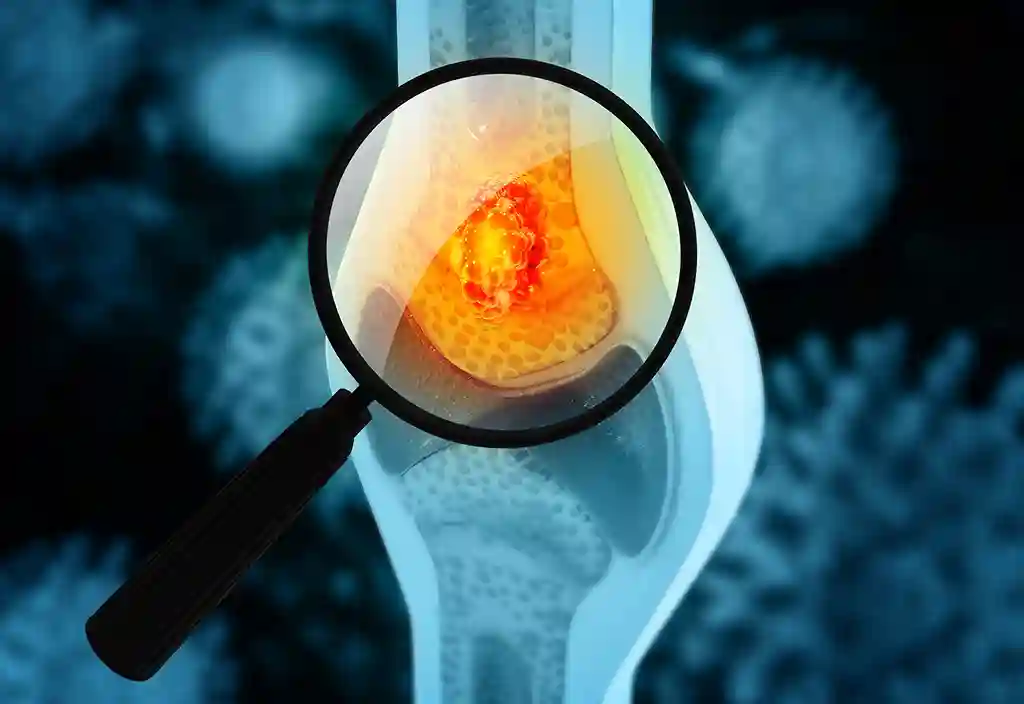 Gejala Kanker Tulang yang Sering Diabaikan, Nyeri Tidak Boleh Disepelekan