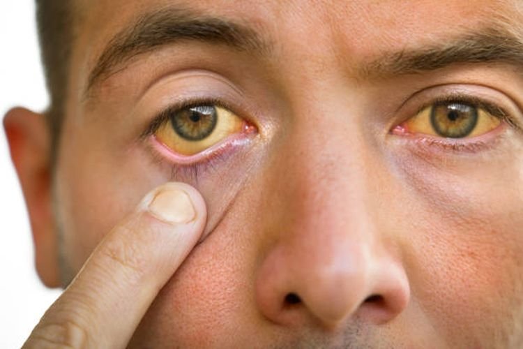 Gejala Sakit Liver yang Sering Diabaikan, Kenali Tanda dari Tubuh Sejak Awal